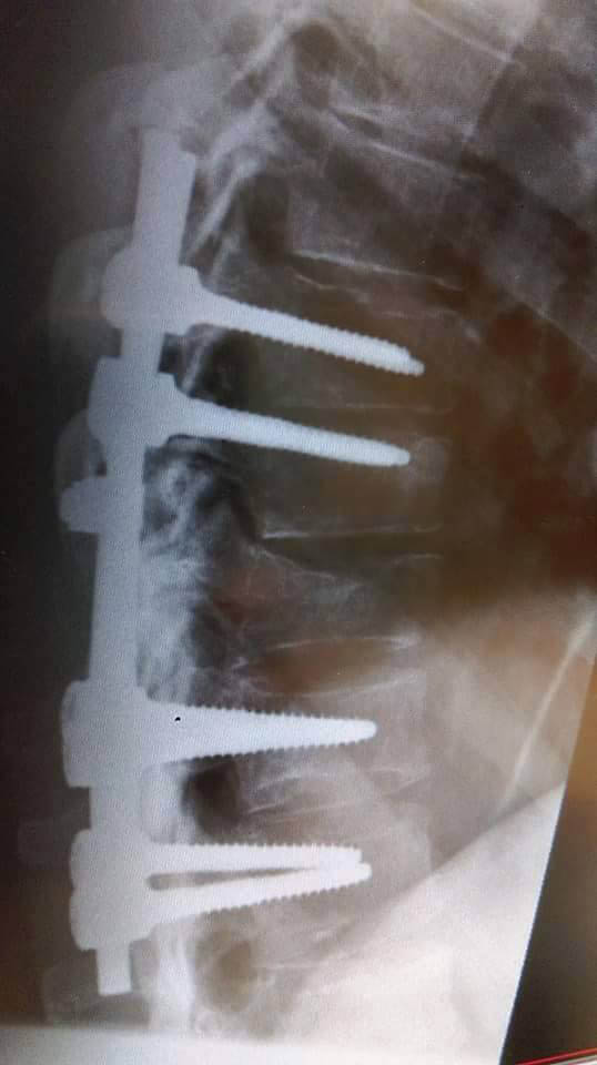 An x-ray of Dave Tighe's spine An x-ray of Dave Tighe's spine